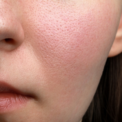 lợi ích của Hyaluronic Acid,