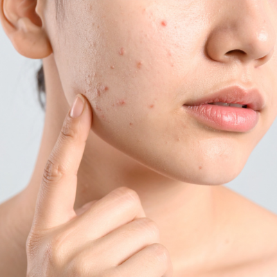 DA MỤN CÓ DÙNG SERUM 14+ SEOUL ĐƯỢC KHÔNG? 