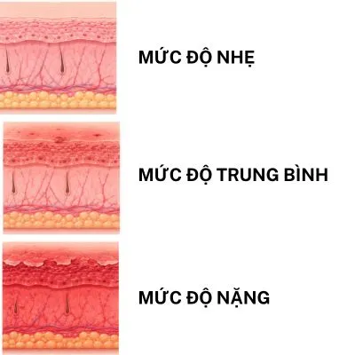 da bị cháy nắng