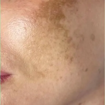 da mặt bị thâm nám