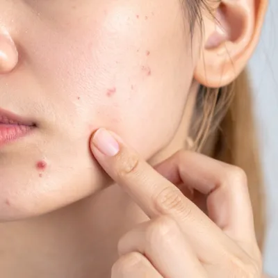 có nên nặn mụn