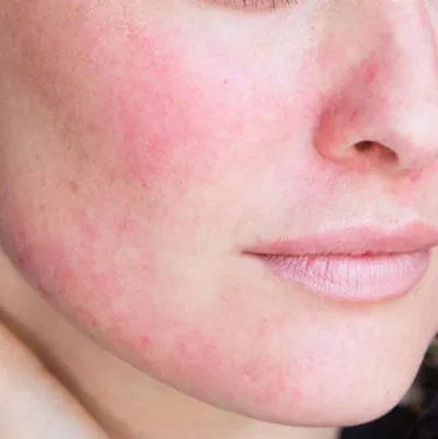 routine da nhạy cảm