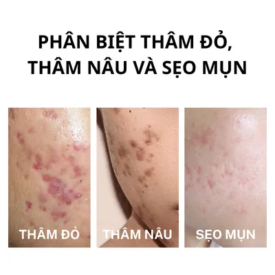 thâm đỏ sau mụn