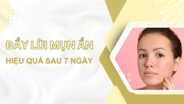 Đẩy lùi mụn ẩn
