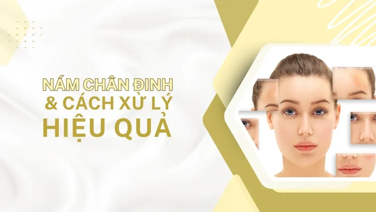 Nám chân đinh và cách xử lý