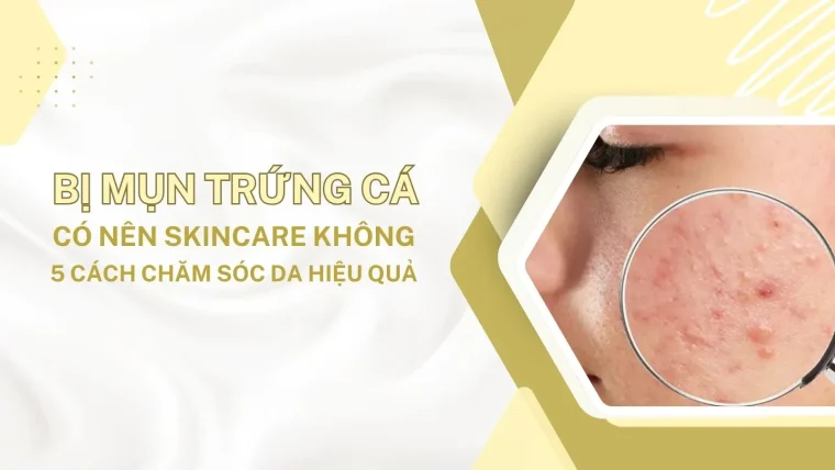mụn trứng cá