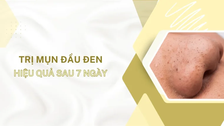 cách trị mụn đầu đen sau 7 ngày