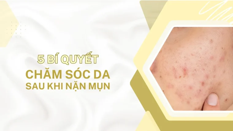 chăm sóc da sau nặn mụn tại nhà