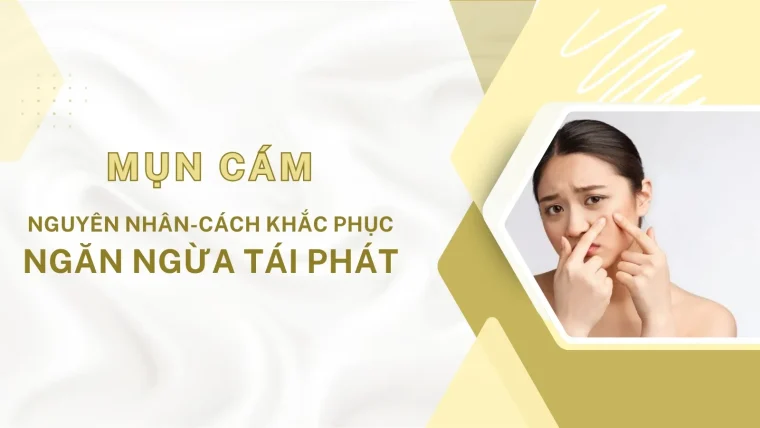 Mụn cám