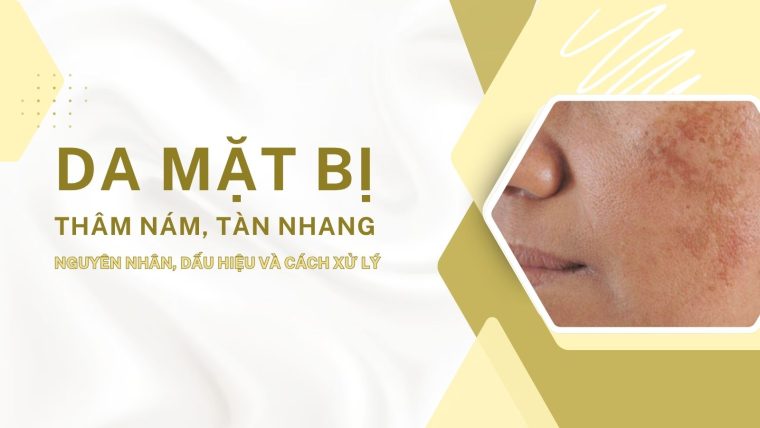 Da mặt bị thâm nám