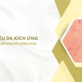 dấu hiệu da kích ứng