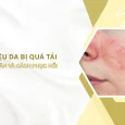 da bị quá tải