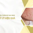 thâm đỏ sau mụn