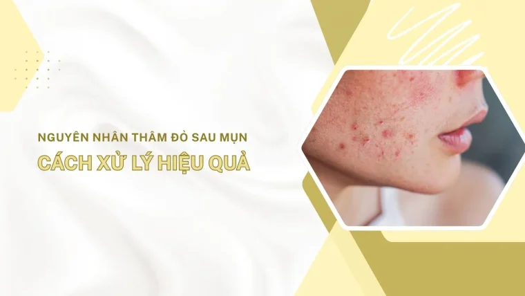 thâm đỏ sau mụn